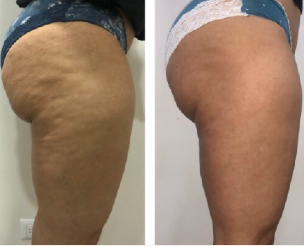 Resultados antes y después de reducción de celulitis, muslos y glúteos más lisos