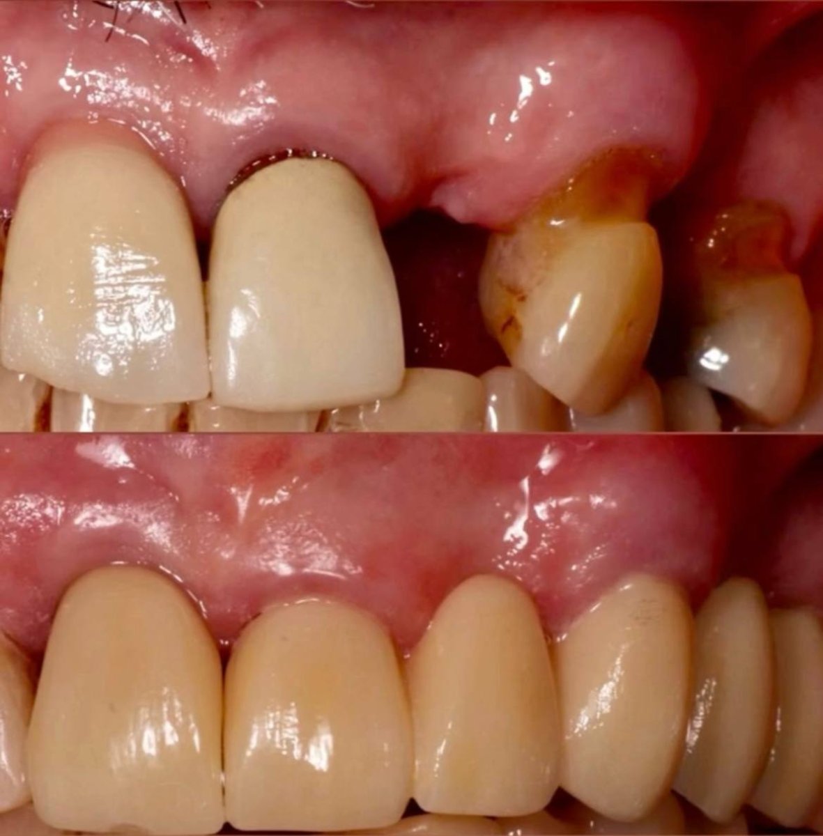 Before and after endosteal implant results – restored upper teeth and improved gum health