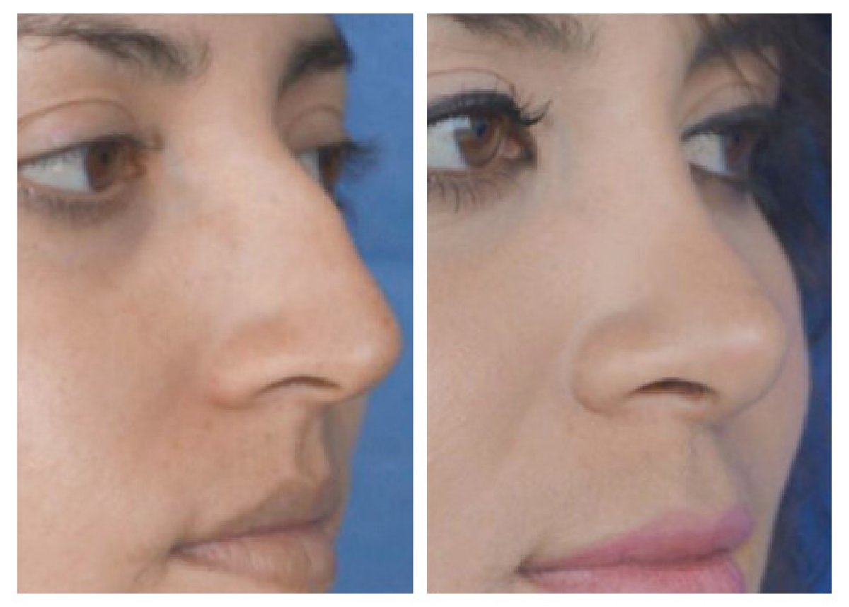 Before and after rhinoplasty results, nose reshaping for improved profile and symmetry