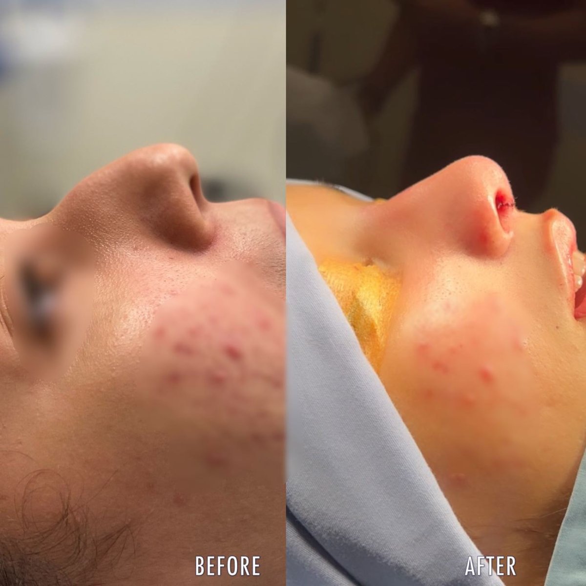 نتائج عملية تجميل الأنف قبل وبعد، إعادة تشكيل واضحة وتحسين مظهر الأنف