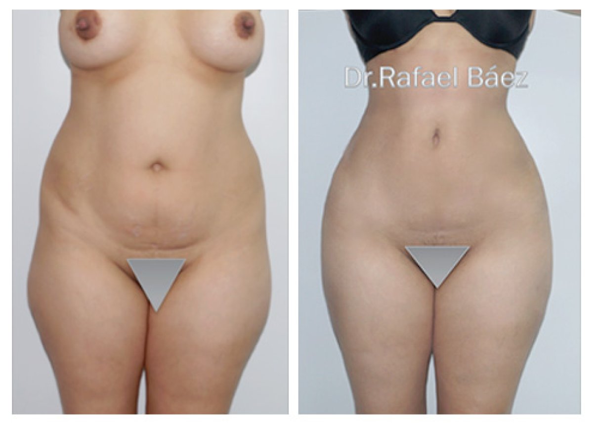 Before and after liposuction results by Dr. Rafael Báez – visible abdominal contour improvement