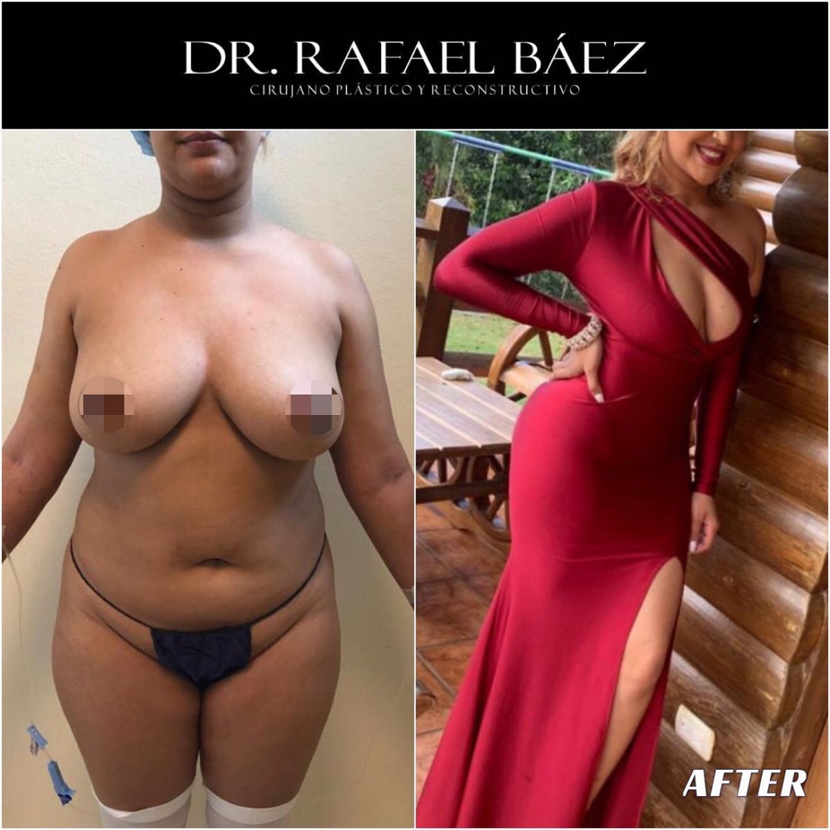 نتائج شفط الدهون قبل وبعد في عيادة Dr. Rafael Báez – تحسين شكل الجسم