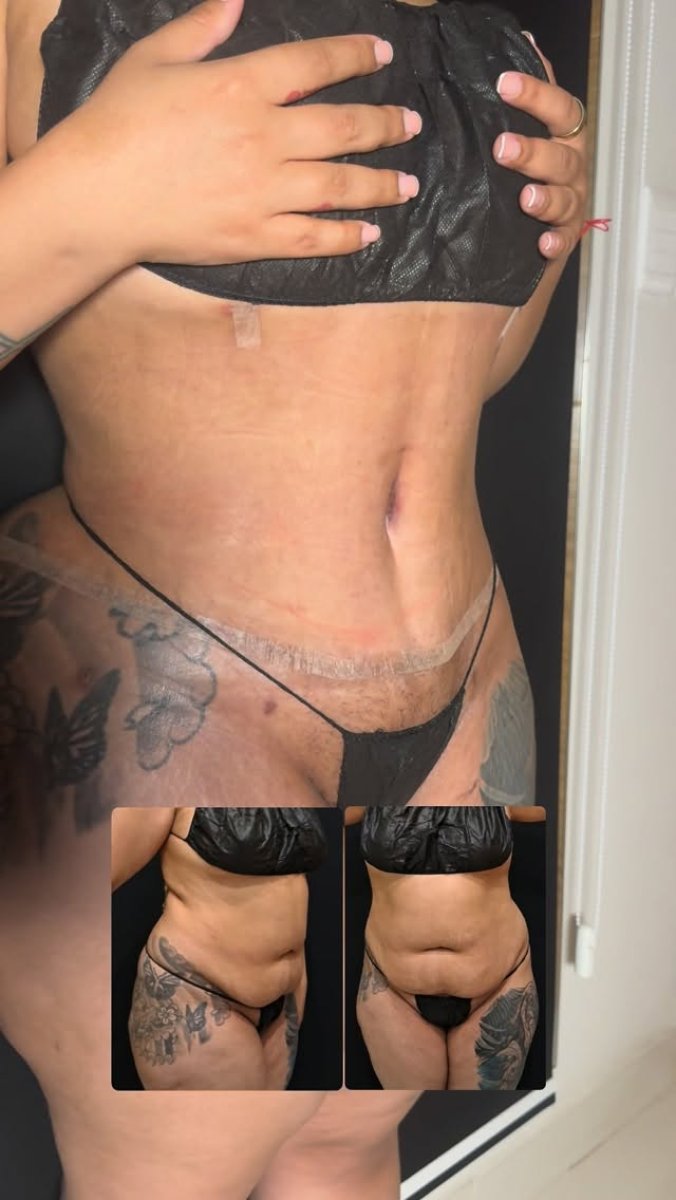 Before and after tummy tuck results – visible abdominal contour improvement after surgery