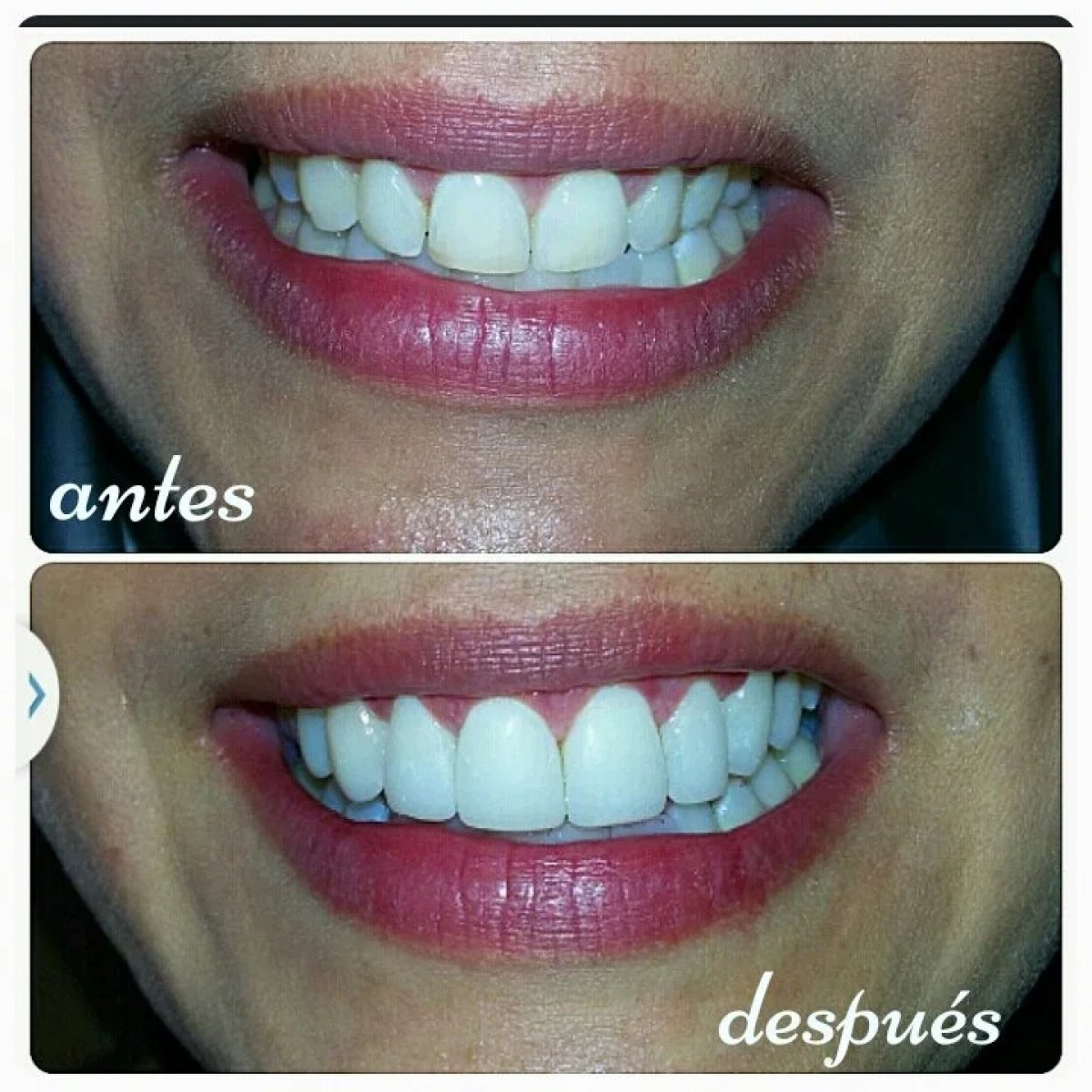 Resultado antes y después de carillas dentales – transformación de la sonrisa