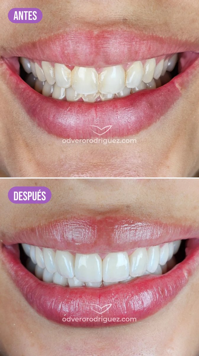 Resultados antes y después de carillas dentales – transformación de sonrisa en odverorodriguez.com