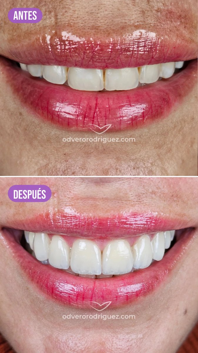 Resultado de carillas dentales antes y después en Odverorodriguez – sonrisa mejorada