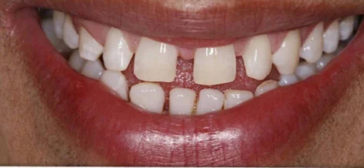 Antes del procedimiento de carillas dentales, se ven huecos y dientes desiguales, resultado