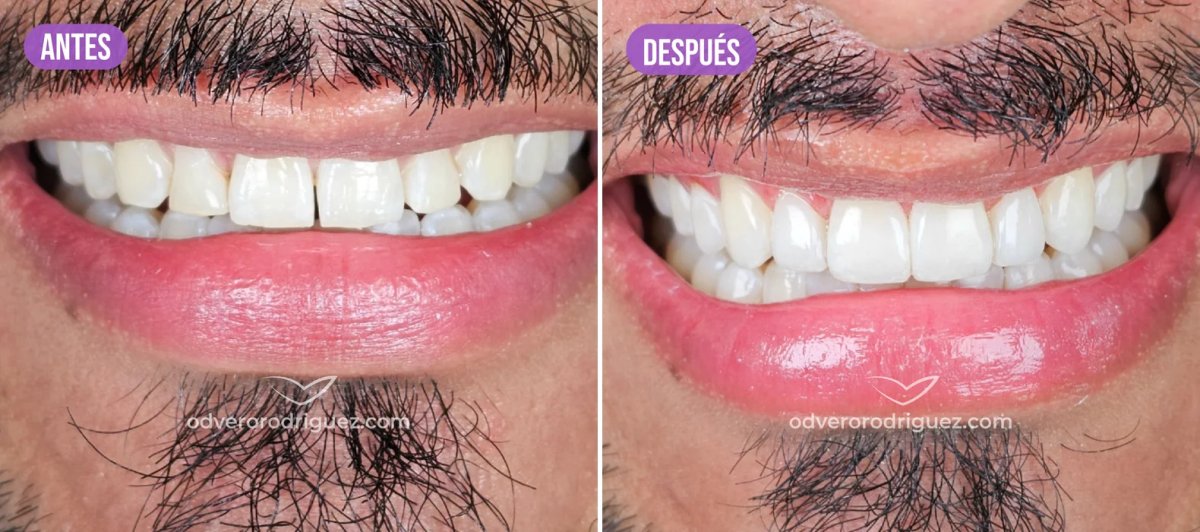Resultados de blanqueamiento dental antes y después – sonrisa más brillante tras el tratamiento