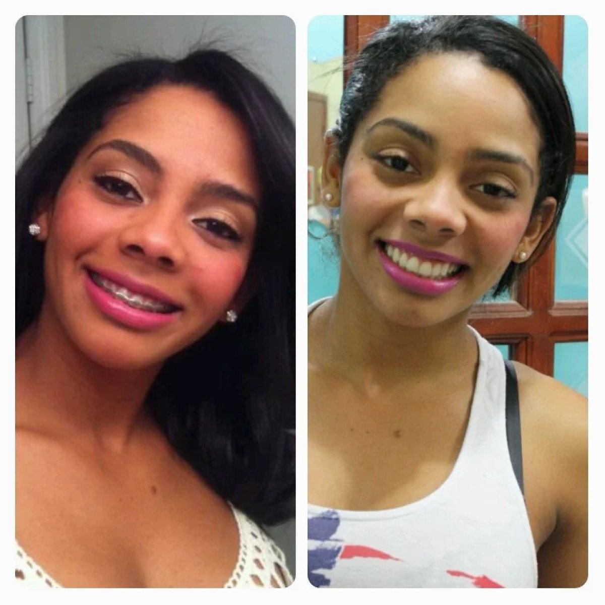 Resultados antes y después de brackets: alineación dental y transformación de la sonrisa