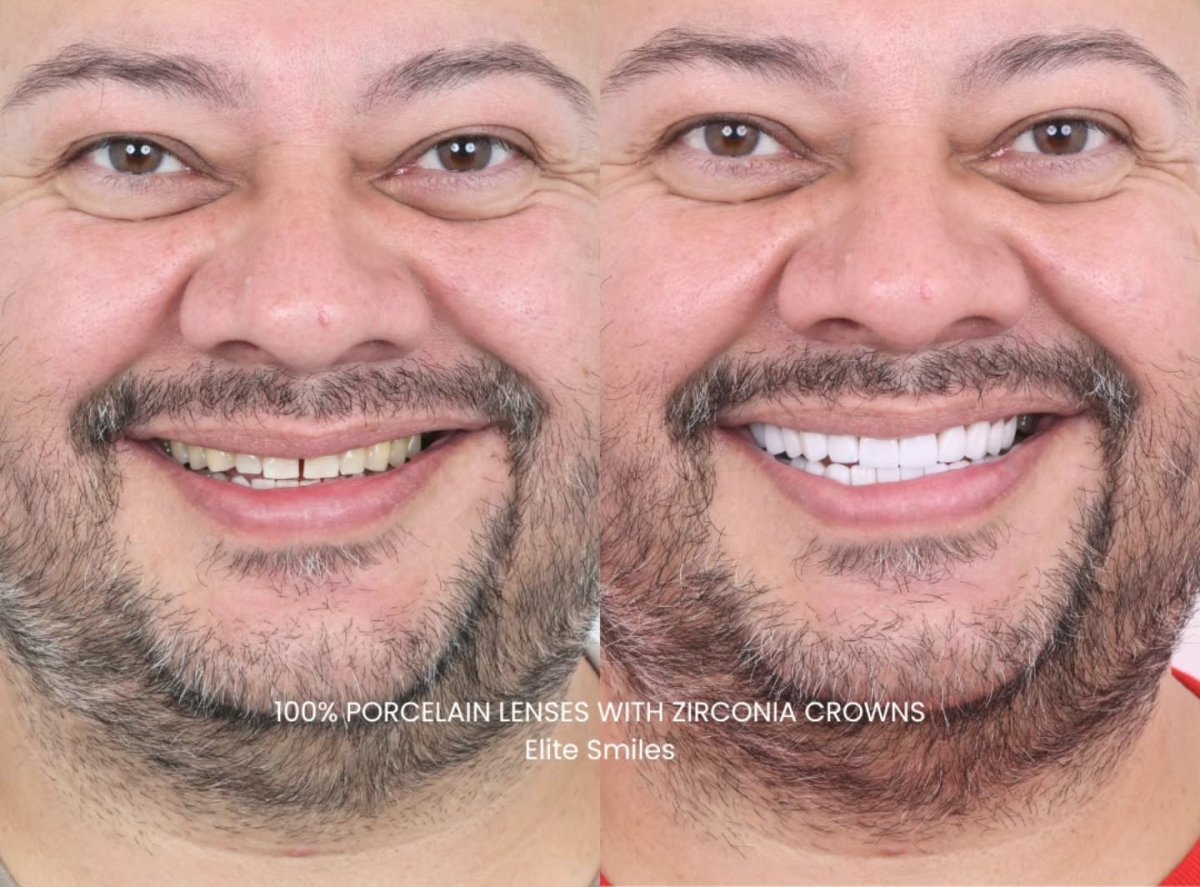 Resultado de carillas de porcelana y coronas de zirconio en Elite Smiles