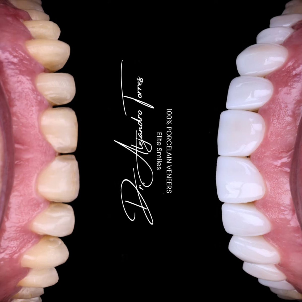 Before and after porcelain veneer results at Elite Smiles clinic, whiter and even teeth