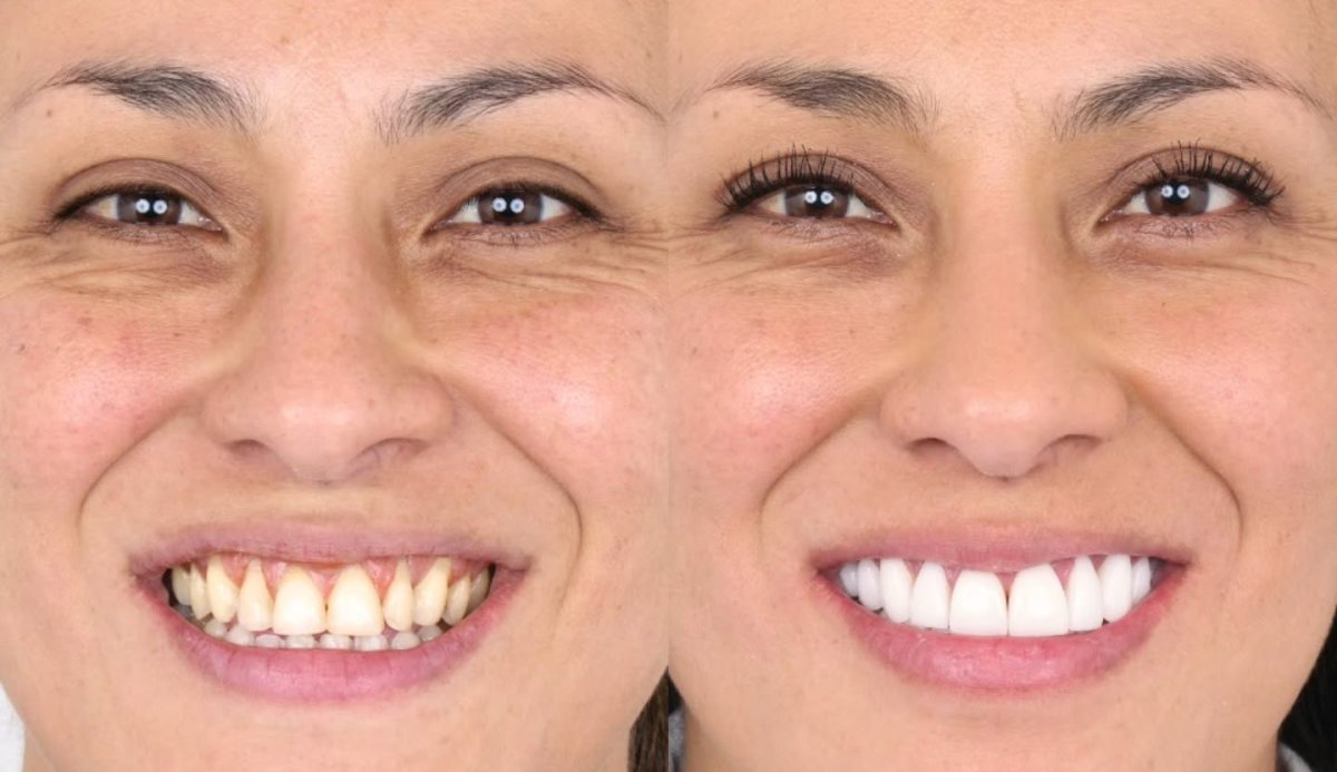 Porcelain veneer before and after results – smile transformation with whiter, even teeth