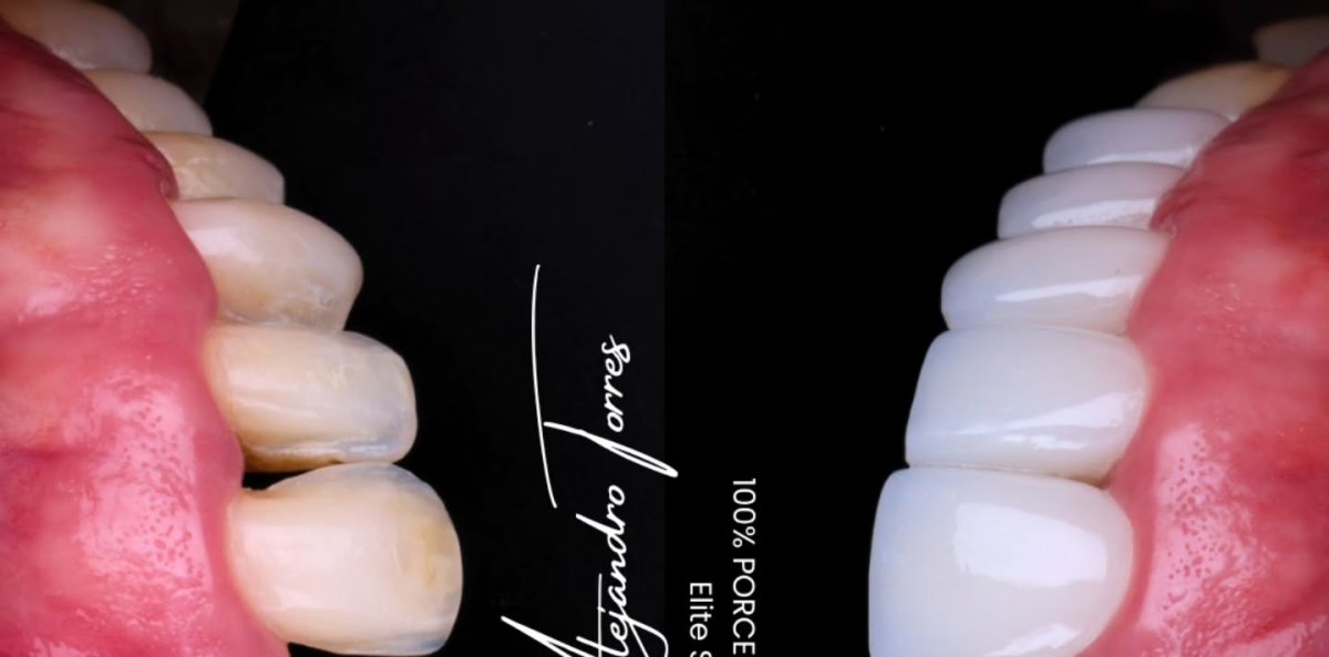 Resultados antes y después de carillas de porcelana, dientes más blancos y uniformes