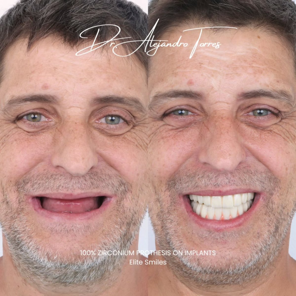 Resultados de implantes dentales antes y después con prótesis de zirconio en Elite Smiles