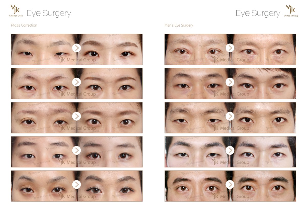 نتائج قبل وبعد جراحة العيون في مركز JK Plastic Surgery، تصحيح تدلي الجفن ورفع الجفن