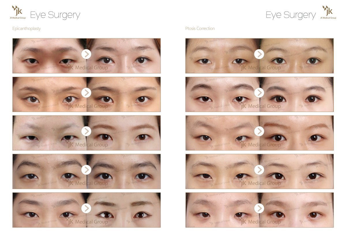 Résultats avant/après chirurgie des paupières doubles au JK Plastic Surgery Center, amélioration des yeux