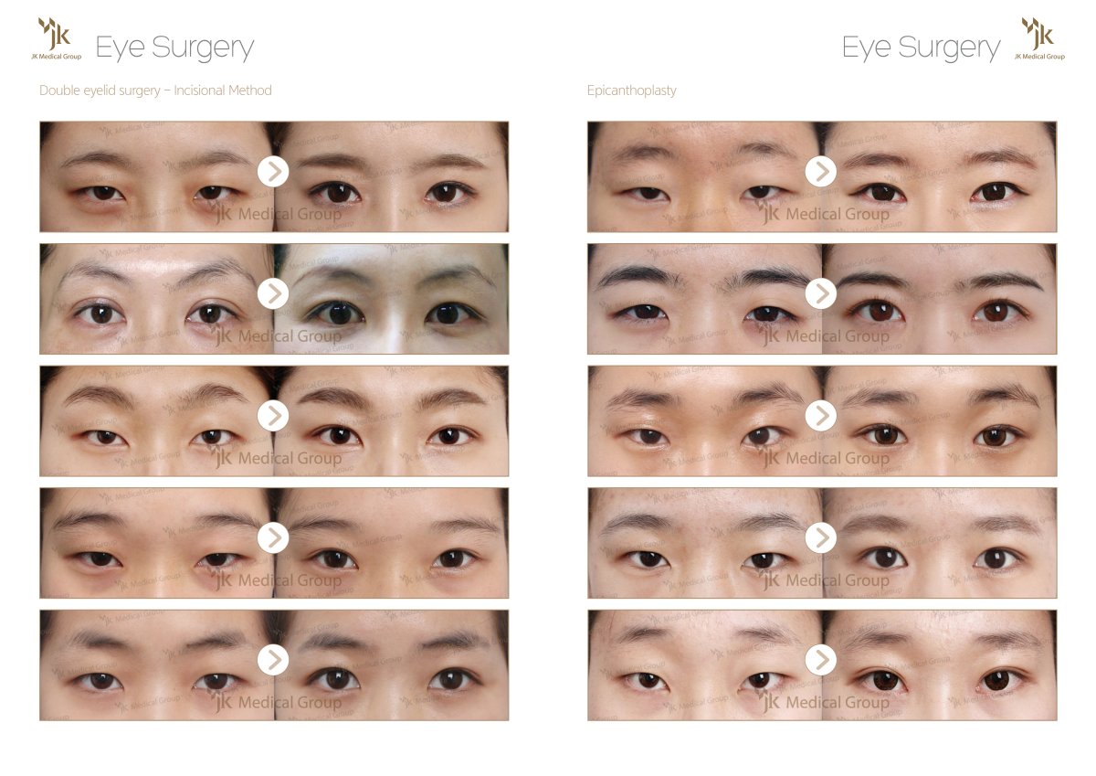 Résultats avant/après chirurgie des paupières doubles au JK Plastic Surgery Center, regard naturel