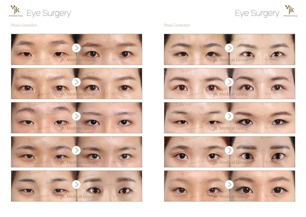 نتائج تصحيح تدلي الجفن قبل وبعد في JK Plastic Surgery Center، تحسين مظهر الجفن