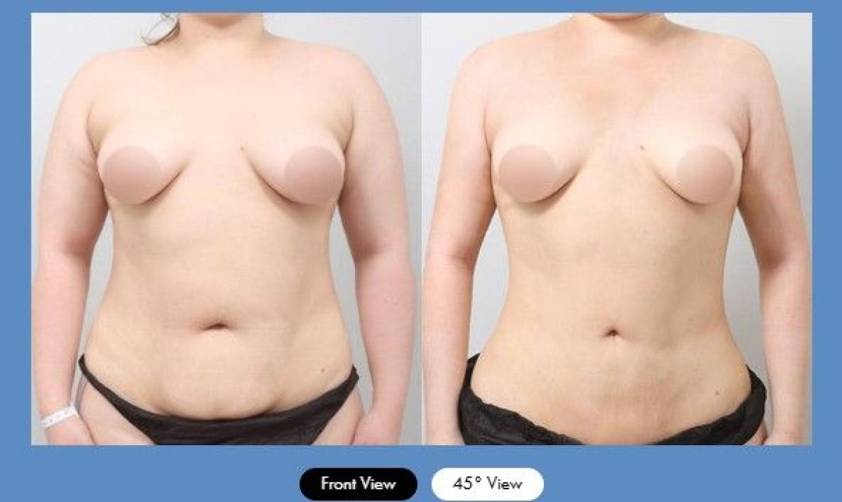 Before and after tummy tuck results at AB Plastic Surgery – visible abdominal contour improvement