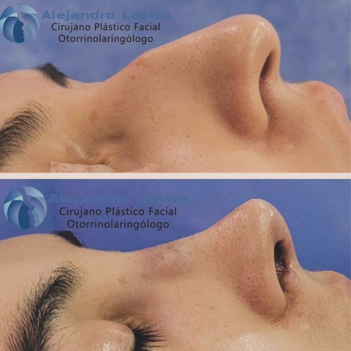 Before and after rhinoplasty results at Alejandro Lastra clinic, nose reshaping improvement