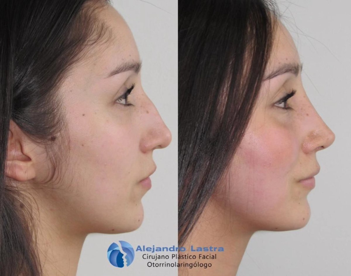 Resultados de rinoplastia antes y después en clínica Alejandro Lastra, perfil nasal mejorado