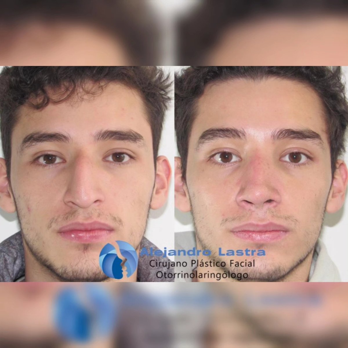 Resultados de rinoplastia antes y después en clínica Alejandro Lastra, forma de nariz mejorada