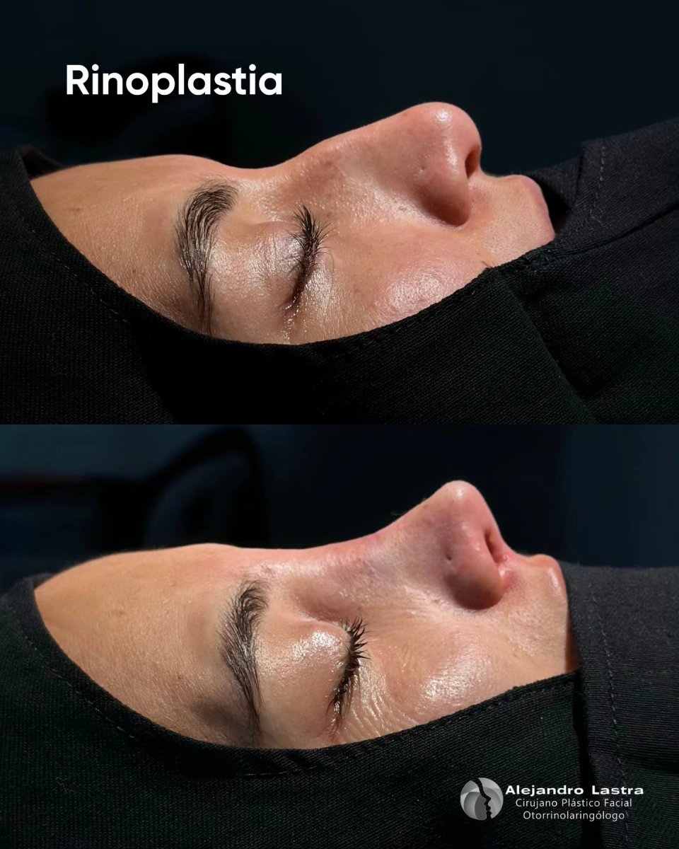 Resultados de rinoplastia antes y después con Dr. Alejandro Lastra, mejora de la nariz