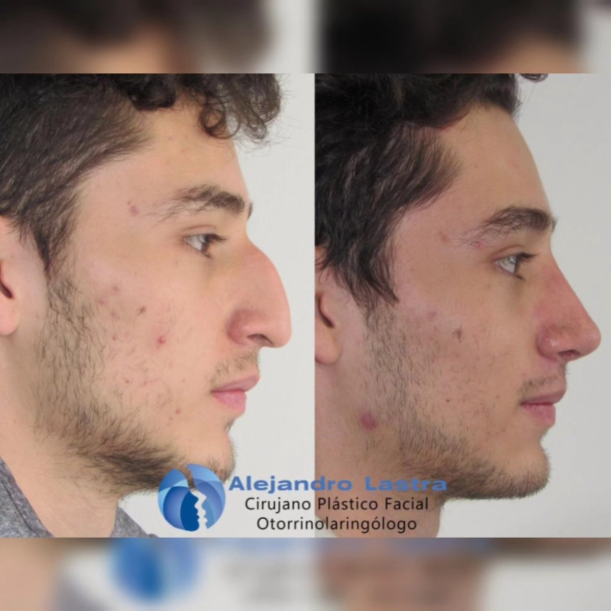 Resultados antes y después de rinoplastia de punta en clínica Alejandro Lastra