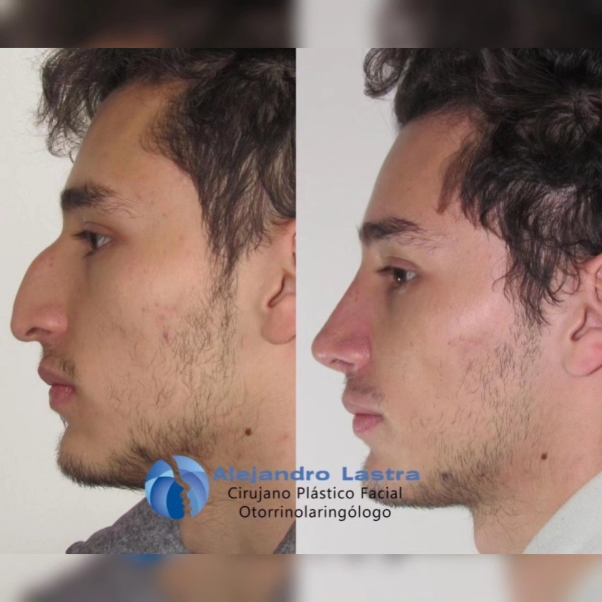 Before and after tip rhinoplasty results at Alejandro Lastra clinic, nose reshaping outcome