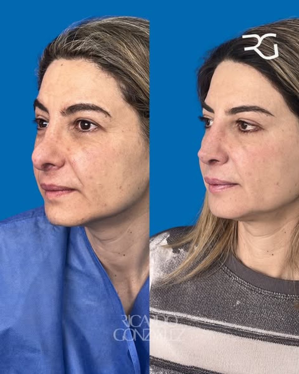 نتائج عملية تجميل الأنف قبل وبعد في عيادة ريكاردو غونزاليس، تحسين شكل الأنف
