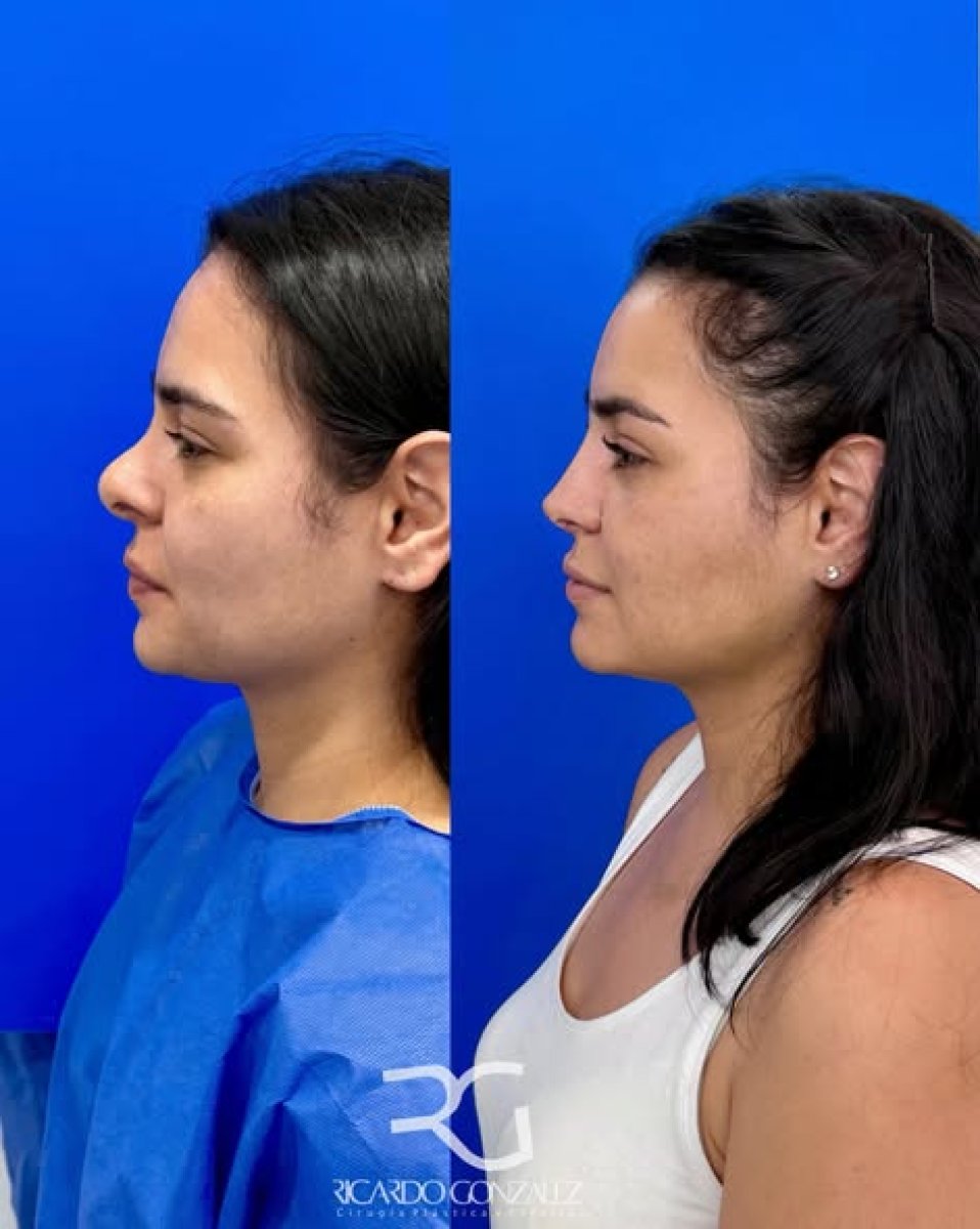 نتائج عملية تجميل الأنف قبل وبعد في عيادة ريكاردو غونزاليس، تحسين شكل الأنف