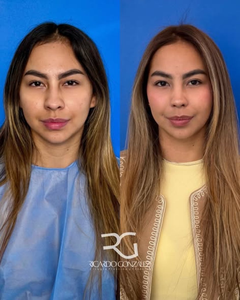 نتائج عملية تجميل الأنف قبل وبعد في عيادة ريكاردو غونزاليس، إعادة تشكيل الأنف