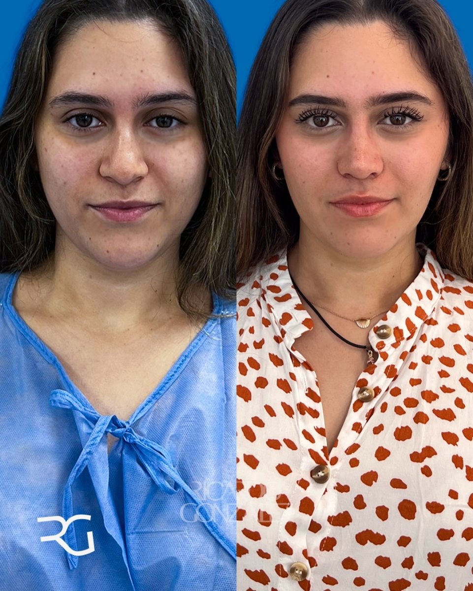 نتائج عملية تجميل الأنف قبل وبعد في عيادة RG – إعادة تشكيل الأنف بمظهر طبيعي