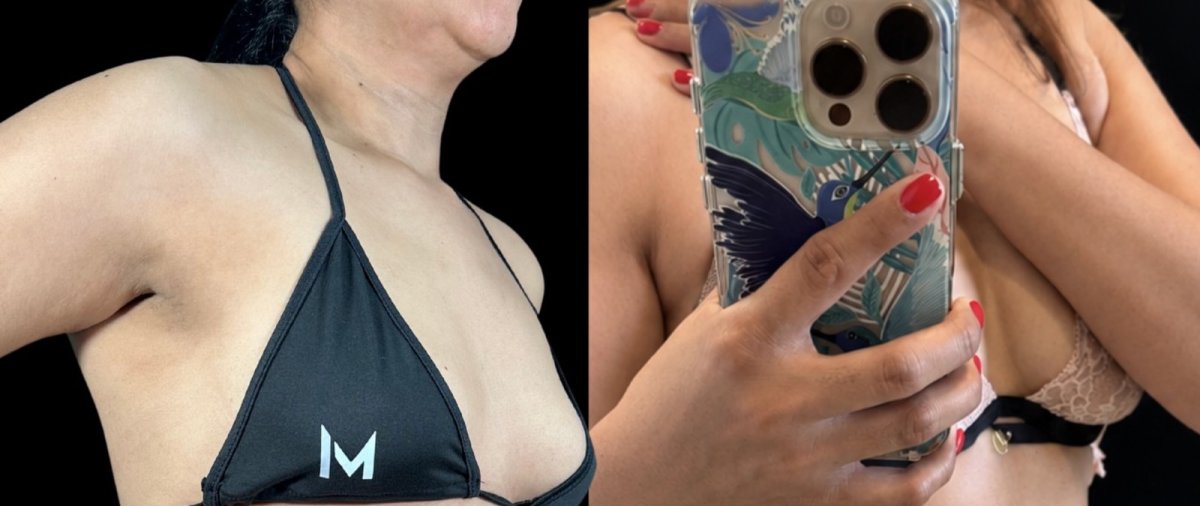 Before and after breast lift results, improved breast contour and firmness after procedure