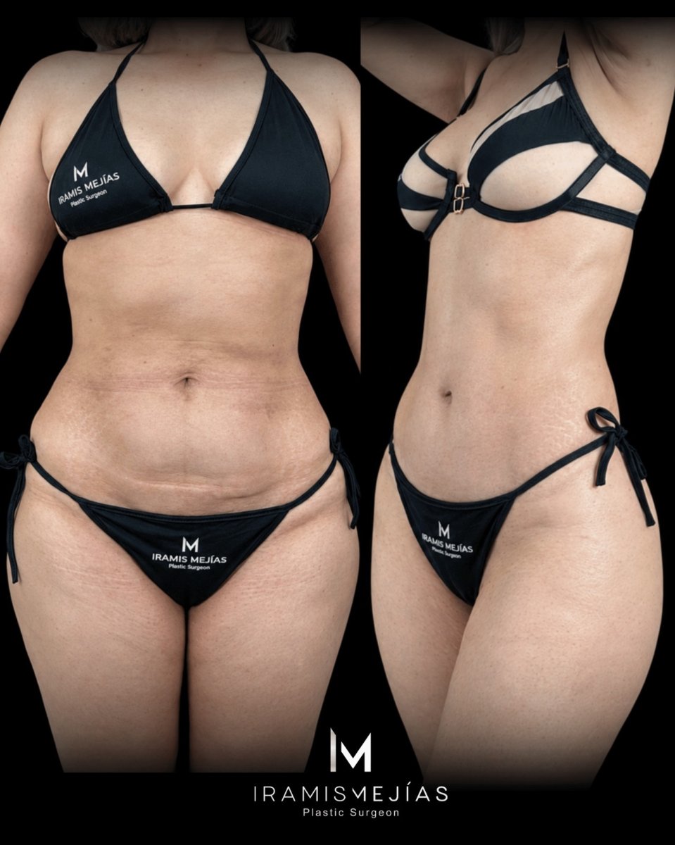 Tummy tuck before and after results at Iramis Mejías clinic – visible abdominal contouring