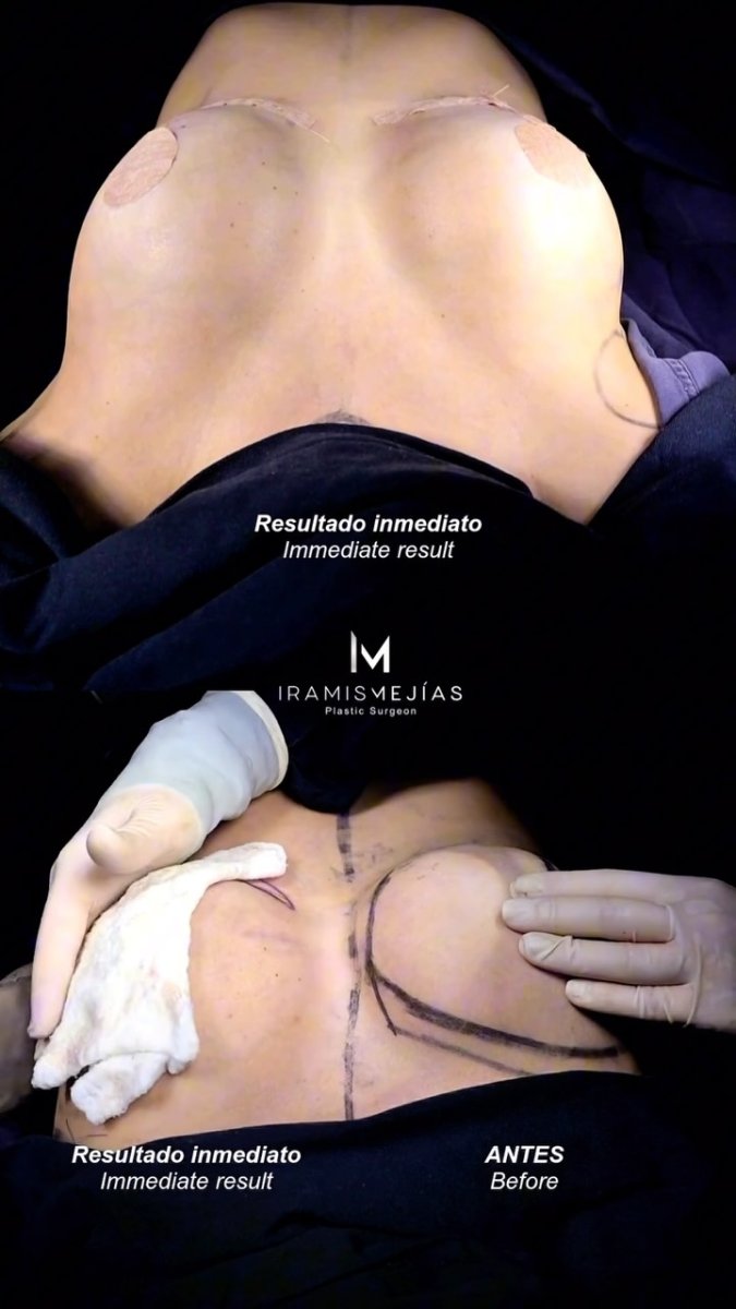 Resultados antes y después de aumento de senos con la Dra. Iramis Mejías, mayor volumen