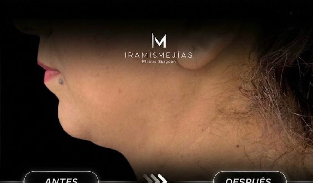 Before and after neck liposuction results at Iramis Mejías clinic – improved jawline contour