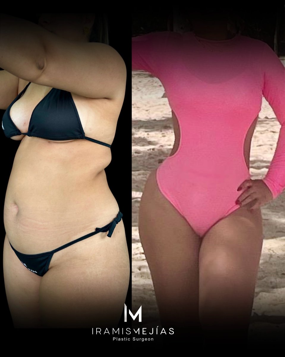 Resultados de abdominoplastia y liposucción antes y después en clínica Iramis Mejías, contorno corporal
