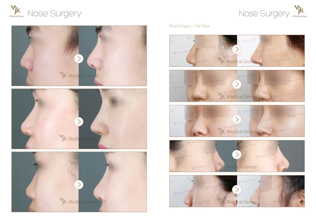 نتائج تجميل الأنف قبل وبعد في مركز JK Plastic Surgery، تحسين شكل الأنف