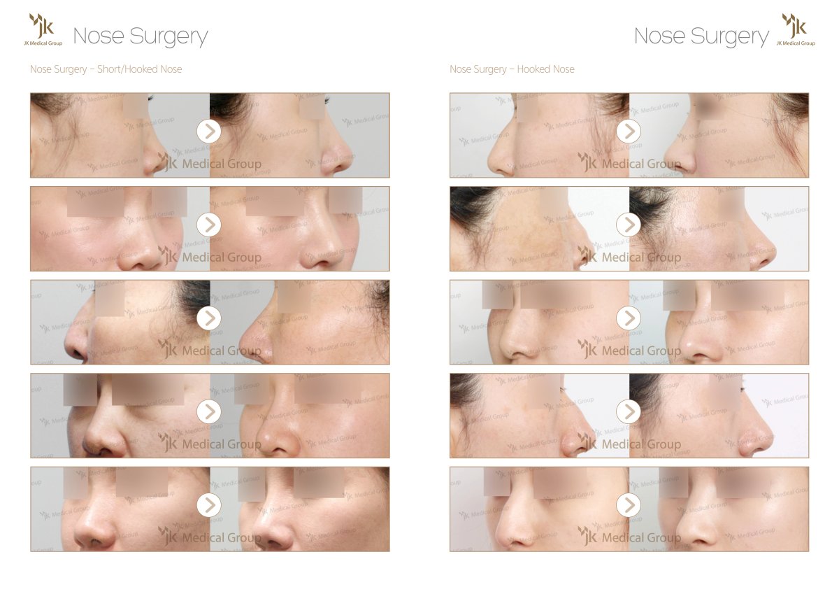 Resultados de rinoplastia antes y después para nariz corta y aguileña en JK Plastic Surgery Center