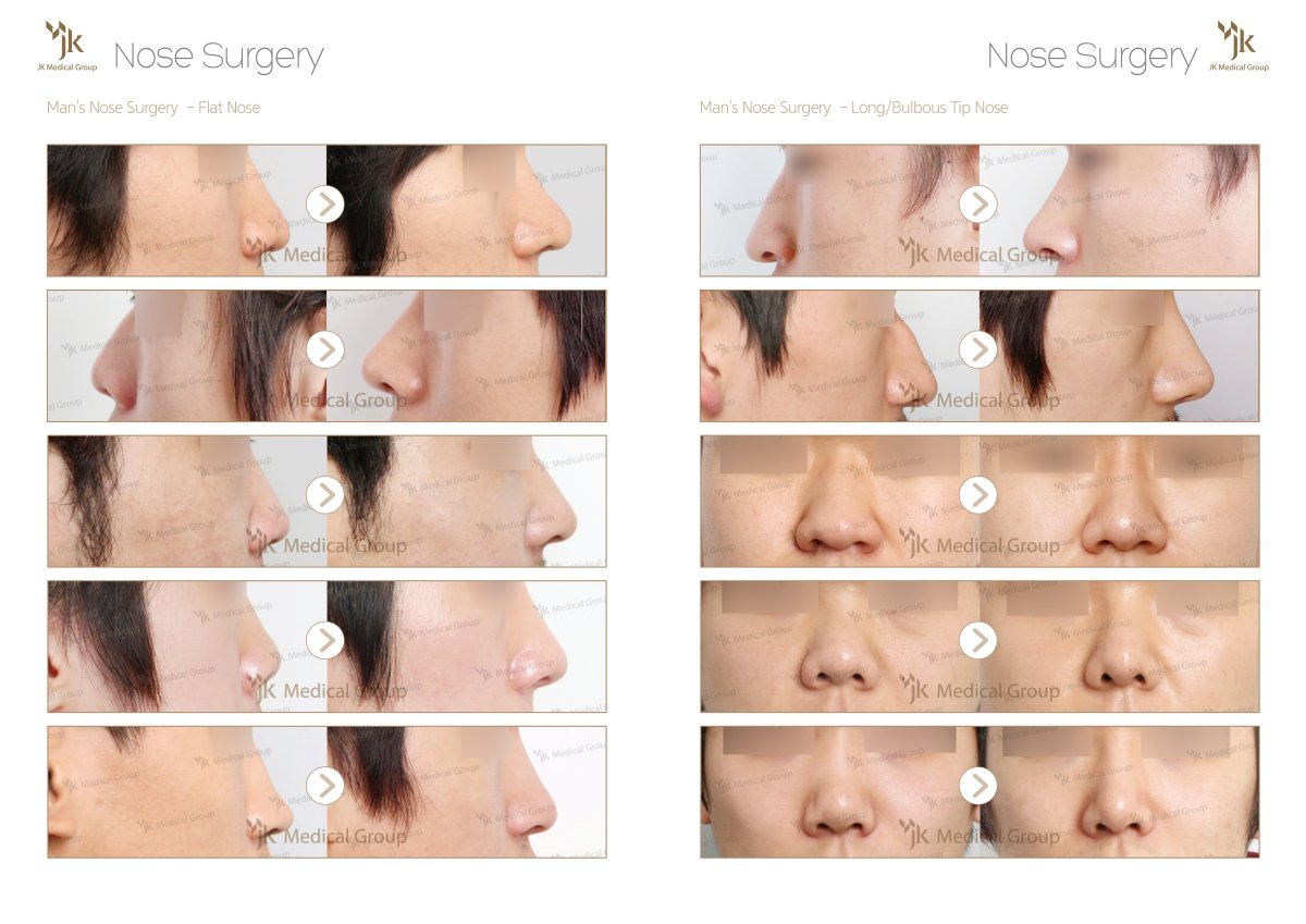 Antes y después de rinoplastia masculina en JK Plastic Surgery Center, corrección de nariz plana y bulbosa