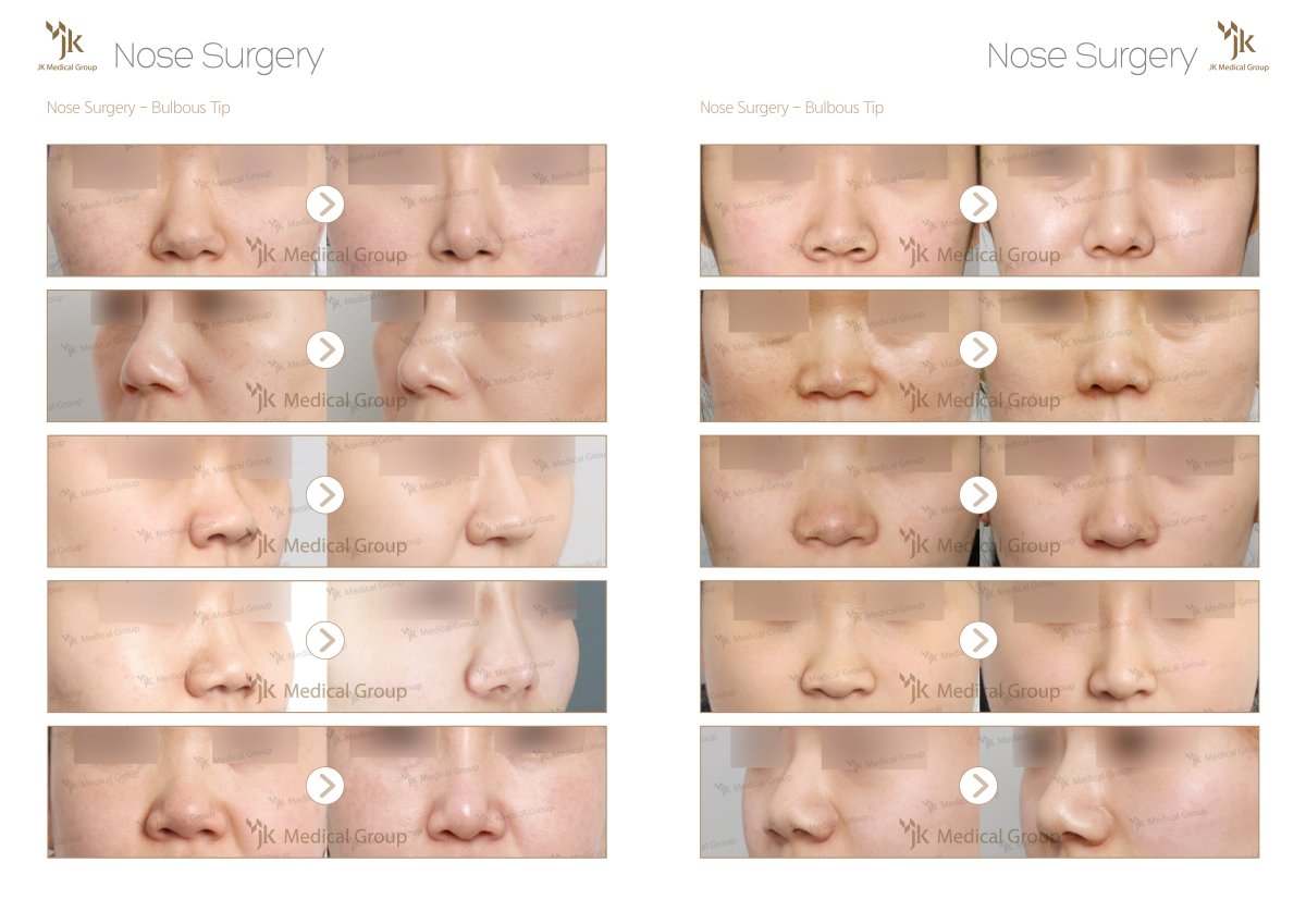 Antes y después de rinoplastia de punta bulbosa en JK Plastic Surgery Center, resultados visibles