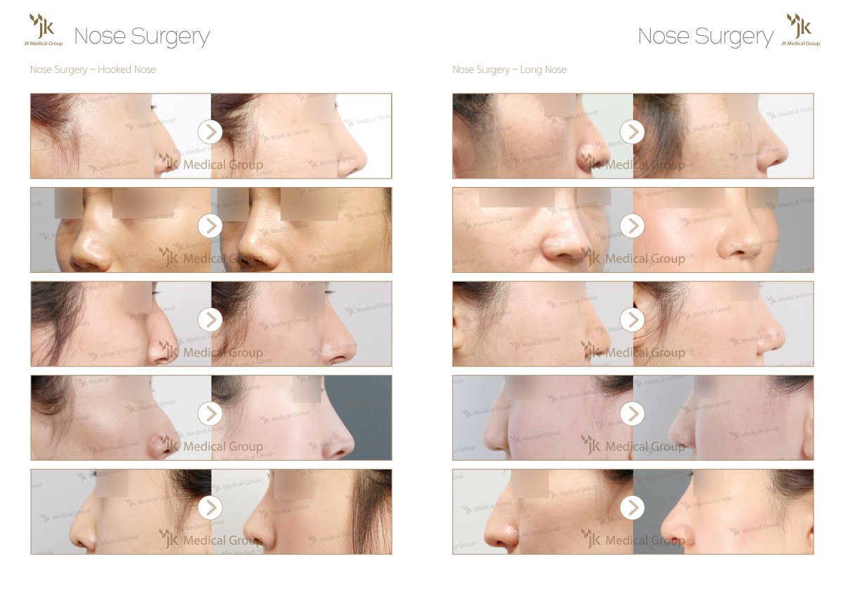 Before and after osteotomy rhinoplasty results for hooked and long nose at JK Plastic Surgery Center