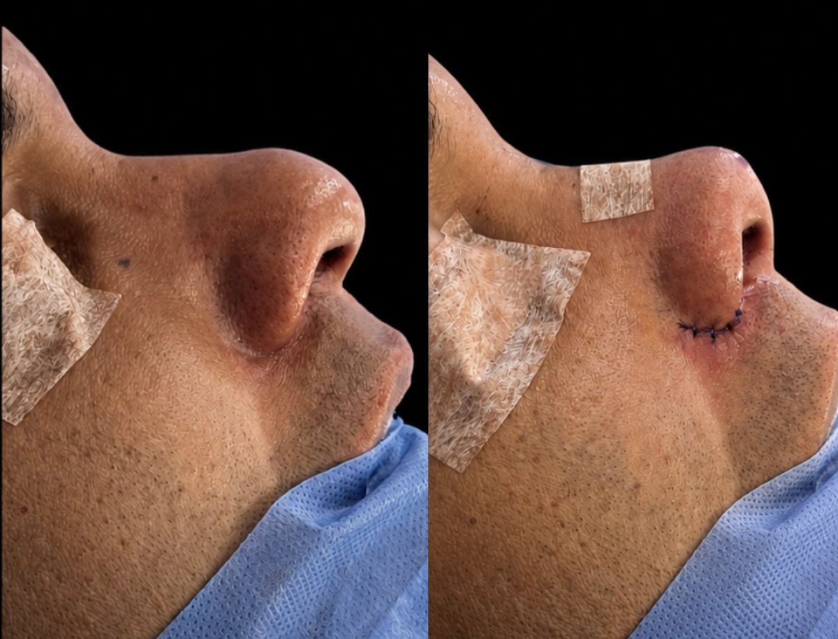 نتائج عملية تجميل الأنف قبل وبعد، إعادة تشكيل الأنف لدى مريض ذكر