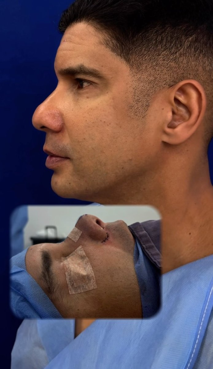 نتائج عملية تجميل الأنف قبل وبعد لدى رجل، تحسين شكل الأنف والملف الجانبي