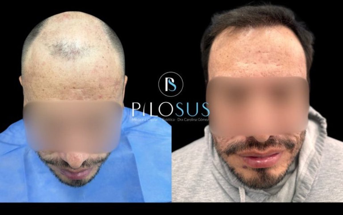 Antes y después de restauración capilar PRP en Pilosus Clinic – resultados visibles