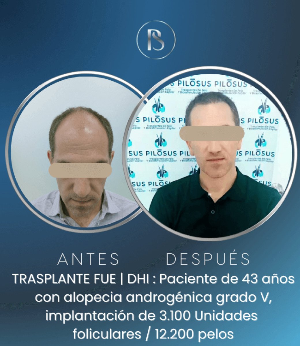 Resultados de trasplante capilar FUE en clínica Pilosus, restauración visible del cabello