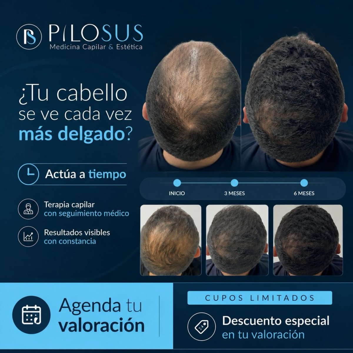 Resultados antes y después de terapia PRP en clínica Pilosus – mejora visible de densidad capilar