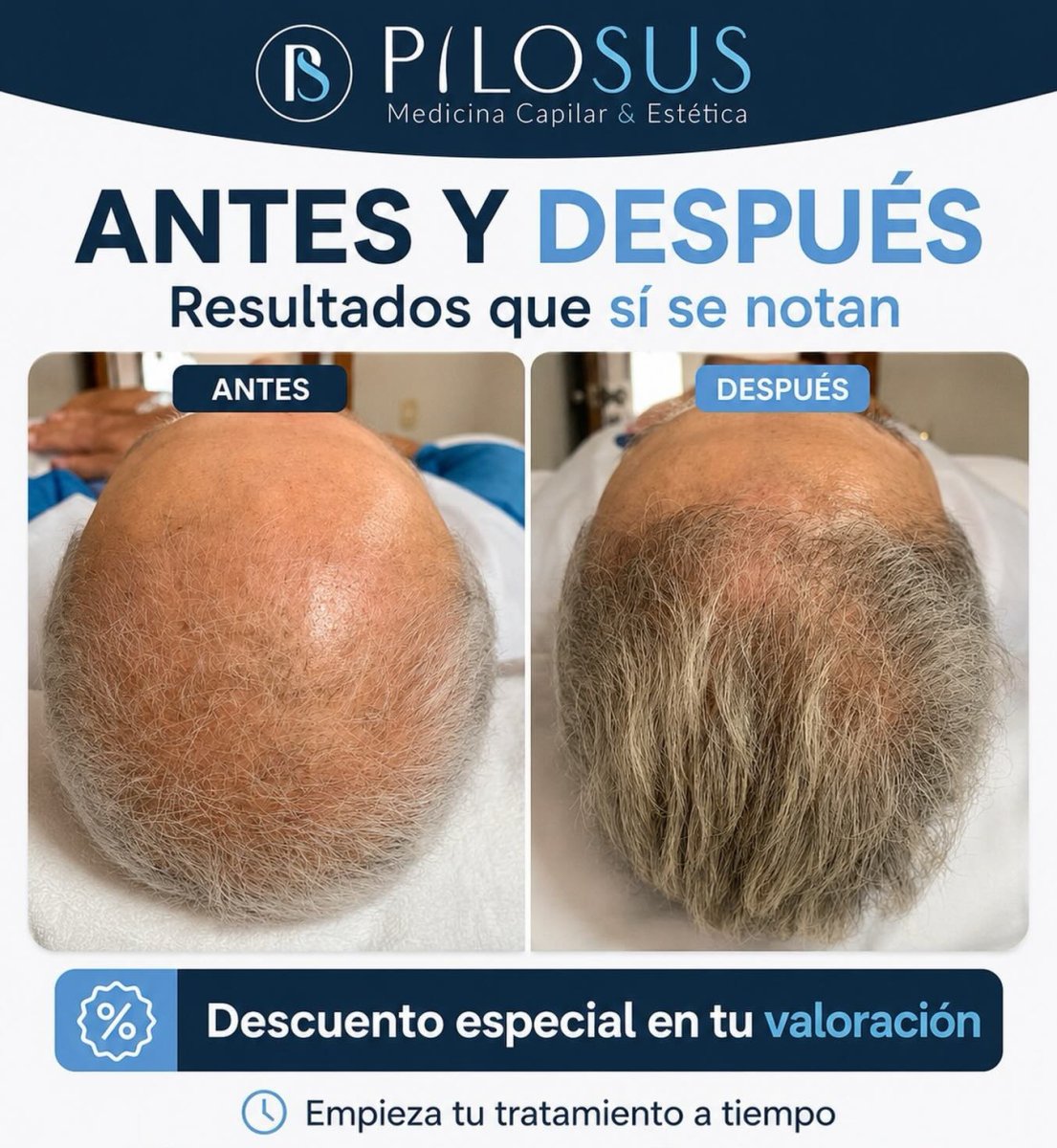 Resultados antes y después de restauración capilar PRP en Pilosus – crecimiento visible