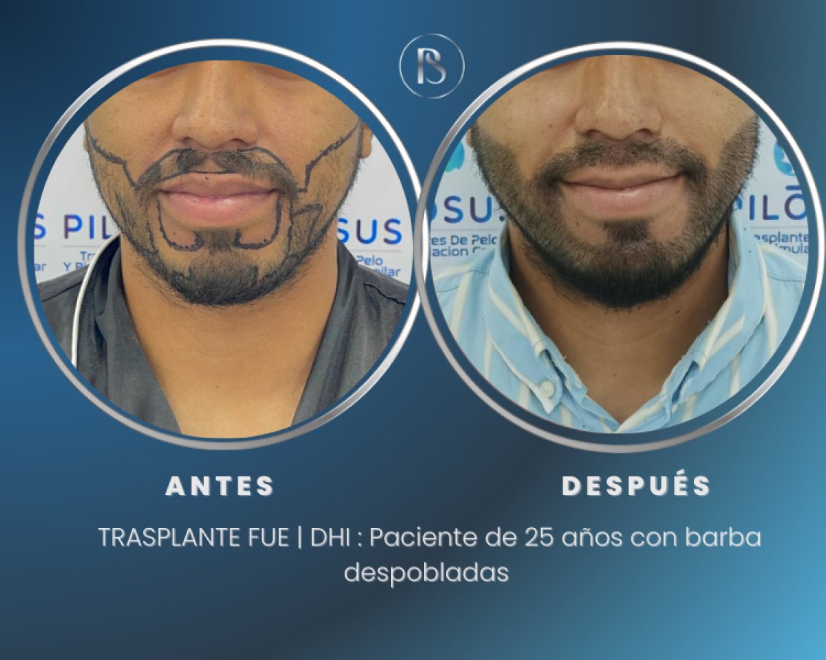 نتيجة قبل وبعد زراعة الشارب واللحية، استعادة كثافة شعر الوجه